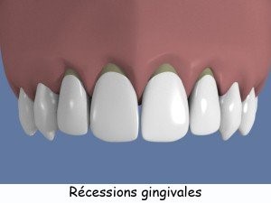 Qu'est-ce qu'une récession gingivale 2