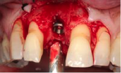 Les implants dentaires - Figure 2