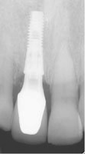 Les implants dentaires - controle